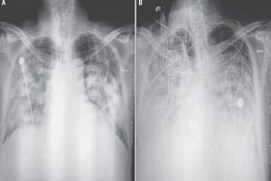 KGMU को मिली कामयाबी, अब X-Ray से भी होगी कोरोना मरीज की पहचान