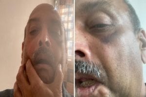 भगोड़े Mehul Choksi की नई तस्वीरें आई सामने, शरीर पर दिखे चोट के निशान