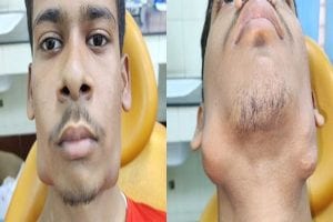 Patna: नीतीश कुमार के मुंह से निकला 82 दांत का गुच्छा, पटना के डॉक्टर ने की सर्जरी