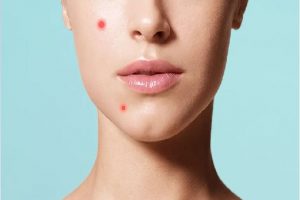 Skin Care Tips: क्या आप भी हैं पिंपल्‍स को पॉप करने की आदत से हैं परेशान, यहां जानें सही तरीका