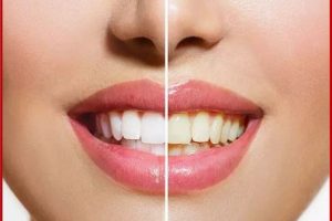 Yellow Teeth Home Remedies: दांतों के पीलापन से हैं परेशान?, इस घरेलू उपायों से पाएं छुटकारा