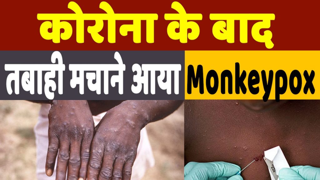 Monkeypox