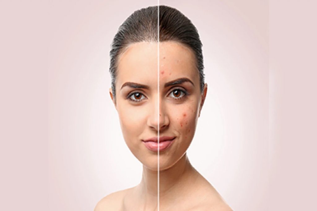 Pimples.