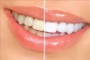 Teeth Cleaning Tips: पीले दांतों से हैं परेशान, घर में मौजूद इस चीज से वापस आएगी चमक, एक बार जरूर करें ट्राई