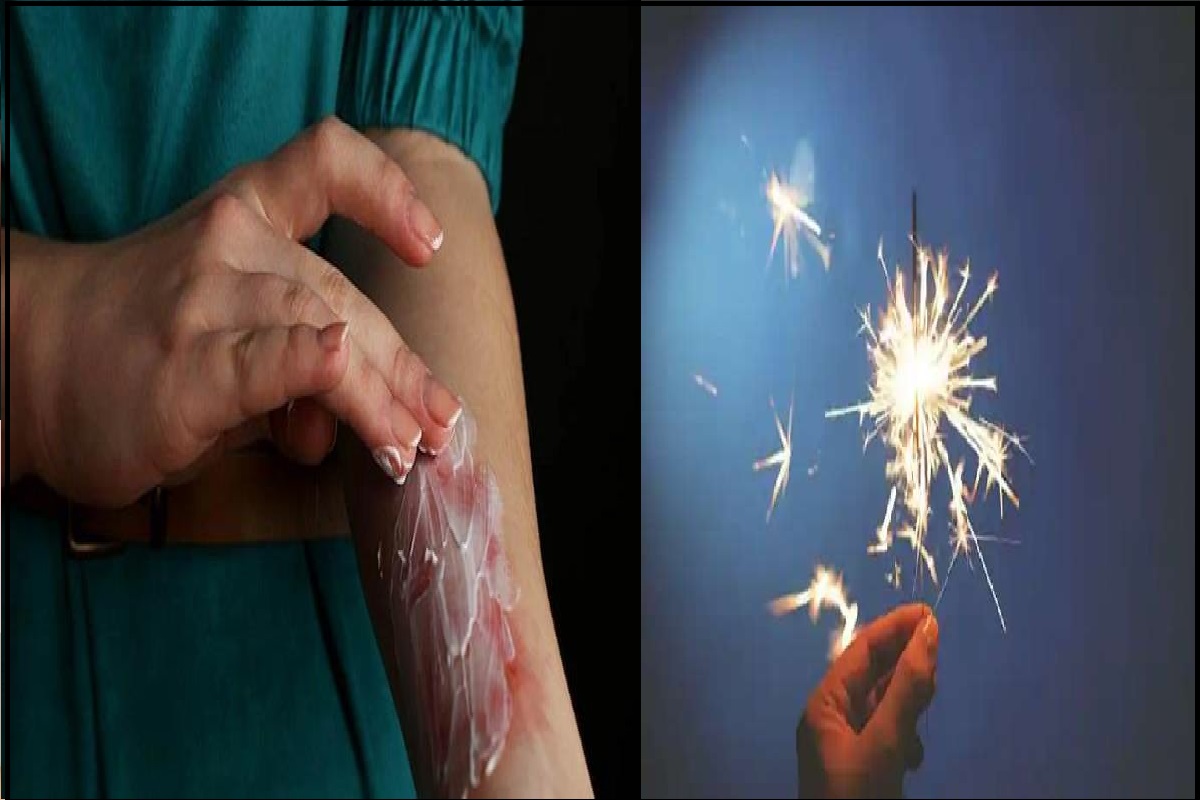 Burn Treatment: अगर आप पटाखें फोड़ते वक्त जल गए हैं तो अभी करें ये उपाय, नहीं पड़ेगा निशान; दर्द से भी मिलेगी राहत