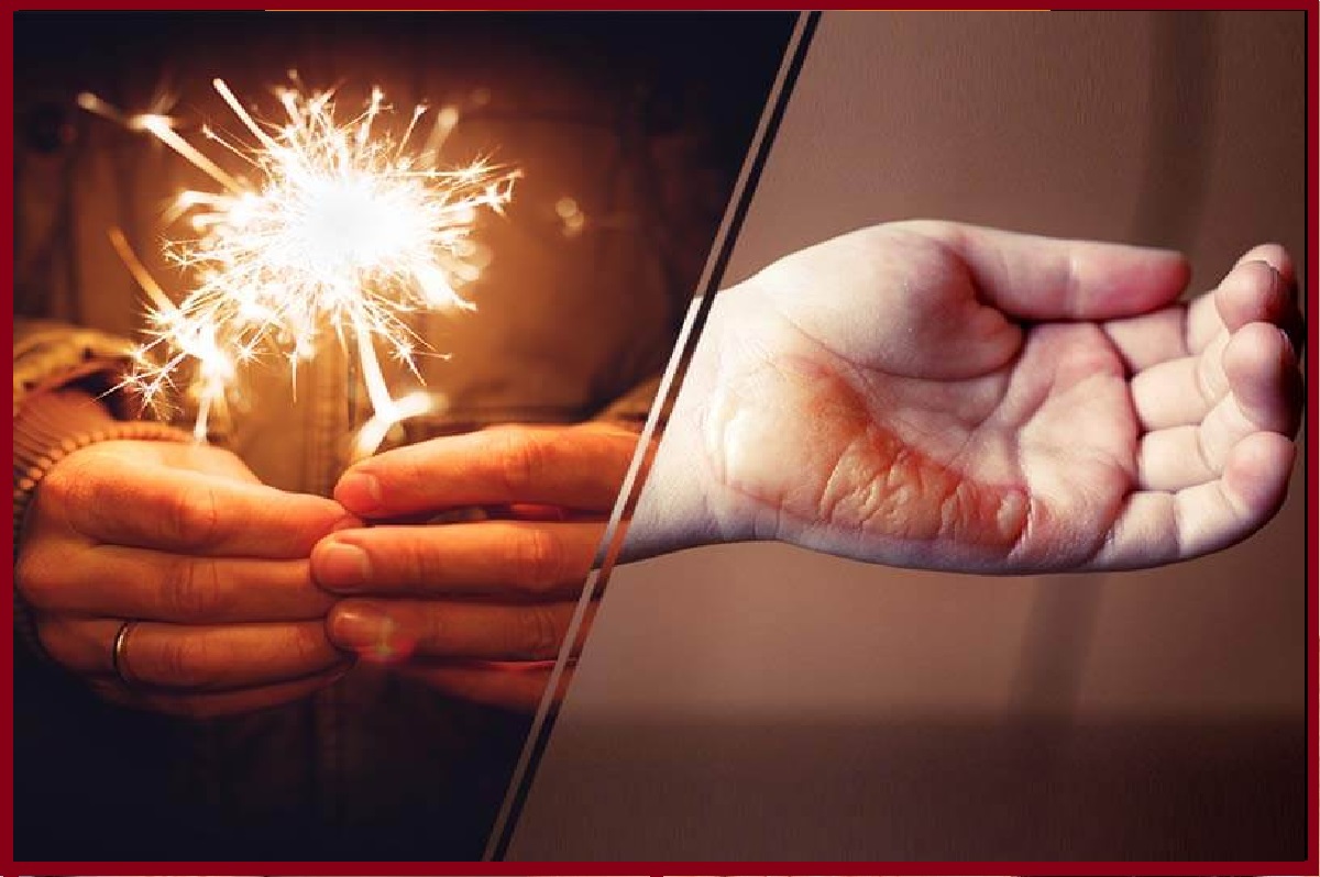 Diwali safety tips: दिवाली में पटाखों से जल जाए हाथ-पैर तो तुरंत करें ये काम, दर्द से भी मिलेगा आराम