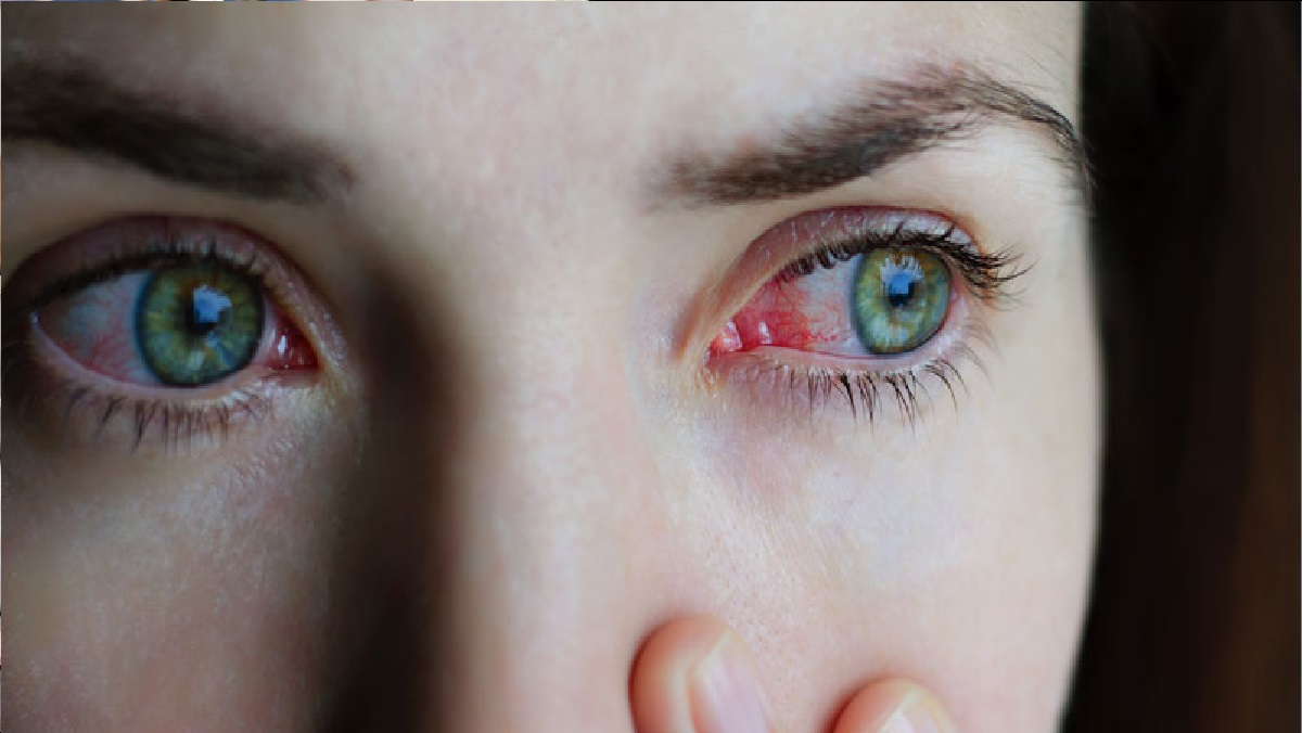Conjunctivitis: तेजी से फैल रही आंखों की बीमारी, जानिए क्या है इसके लक्षण और कैसे करें बचाव