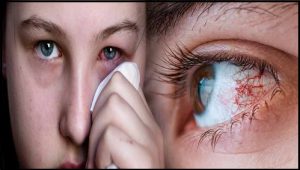 Eye Flu: देश में तेजी से फैल रहा आई फ्लू, एक्सपर्ट ने बताया कैसे करें इससे खुद का बचाव