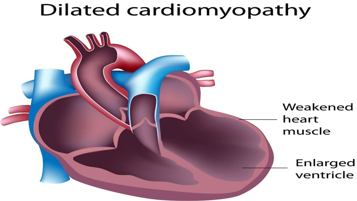 dilated cardiomayopathy